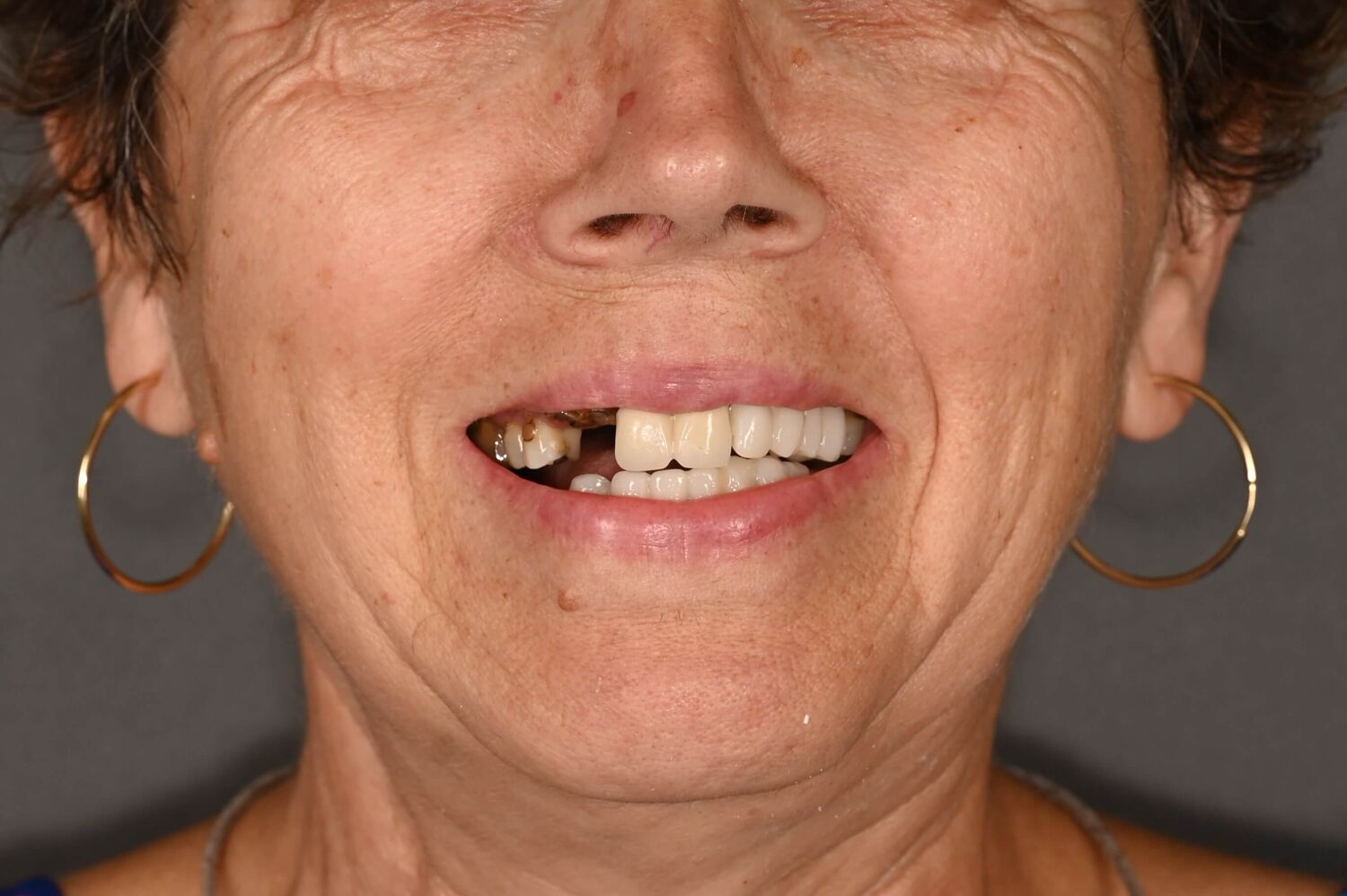 Pacient Clinica Dr. Alin Odor - Rezultat Implantologie